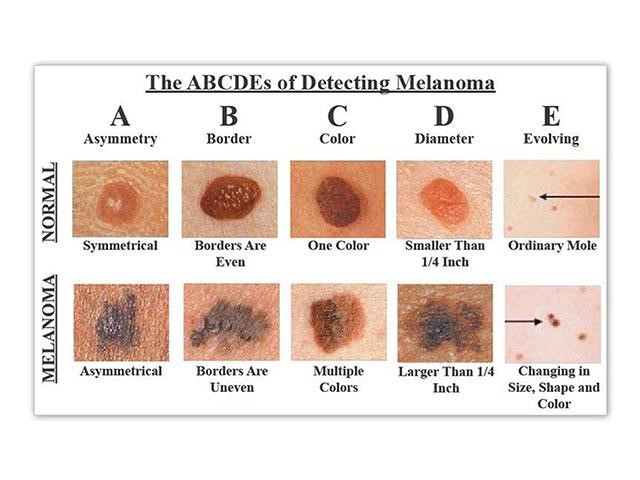 Abcd rule for melanoma