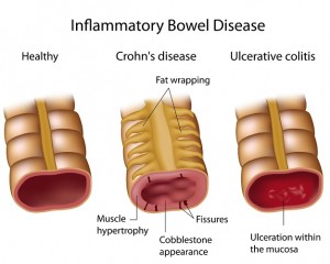 IBD Reduced