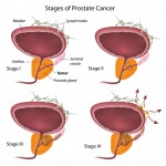 Prostate Cancer Resized