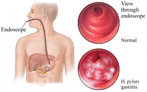 H Pylori Diagram